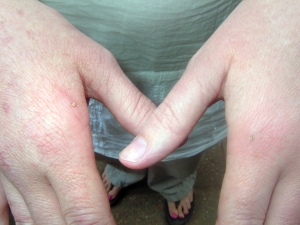 Stings applied to joints on both hands